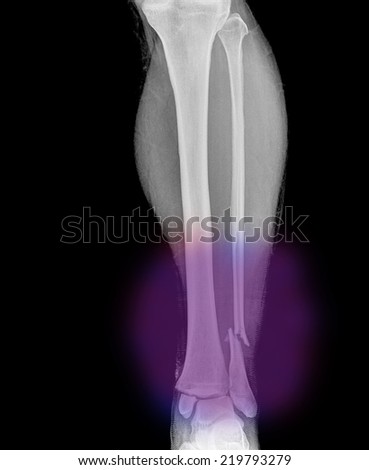 film x-ray ankle lateral : show complete fracture shaft of fibula(leg's bone)