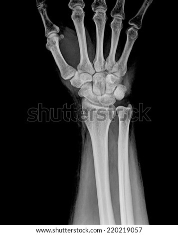 x-ray image show fracture of the radius bone