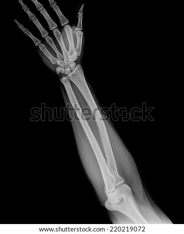 Hand x-ray view on a black background
