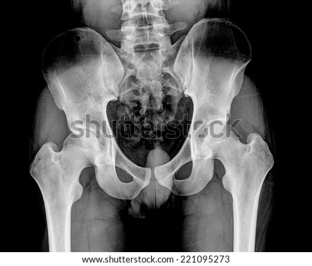 film x-ray pelvis AP : show fracture right femur (thigh\'s bone)