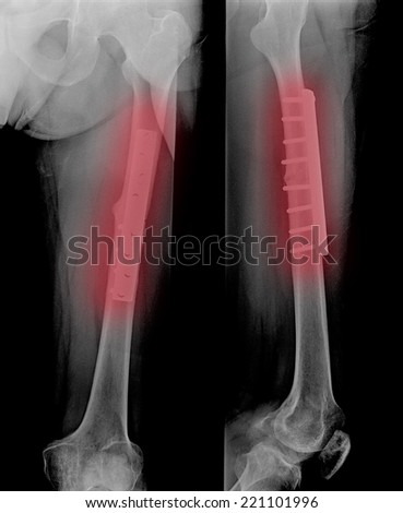 film leg AP/lateral : show fracture shaft of tibia and fibular (leg's bone). patient was operated and insert plate and screw for fix leg's bone