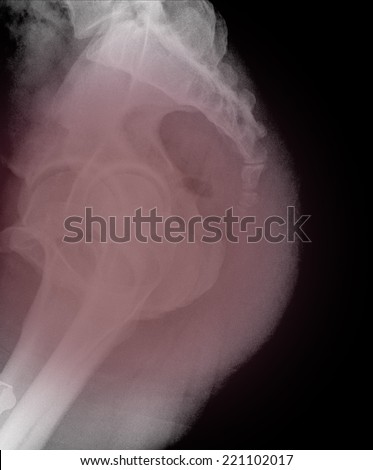 X-ray lumbo-sacral spine (lateral) of asian adult people
