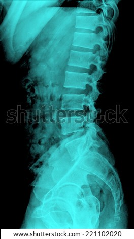 x ray of human lumbar spine lateral