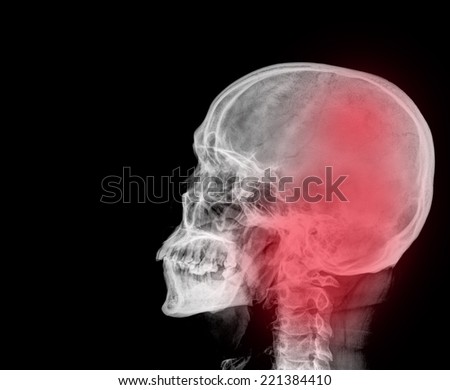 Film x-ray Skull lateral : show normal human\'s skull and cervical spine and blank area at left side