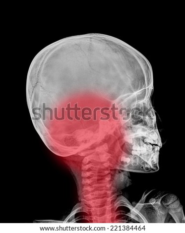 Detail of neck and head x-ray image.