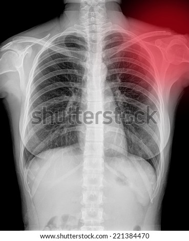 X-Ray Image Of women  Chest for a medical diagnosis