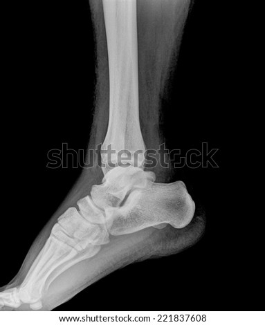 X-ray image of an ankle in the lateral position