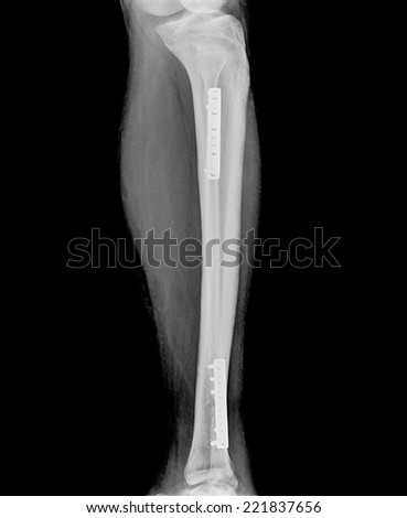 Film x-ray show fracture shaft of tibia and fibular insert plate and screw for fix leg\'s bone