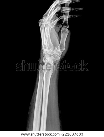 X-ray of human arms and hands