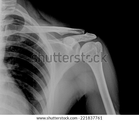 X-ray film of left shoulder fracture ,hold 5kg