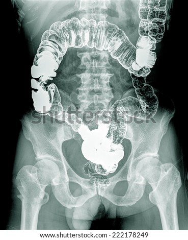 x ray Small bowel , AP view