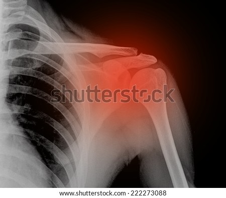 X-ray film of left shoulder fracture ,hold 5kg