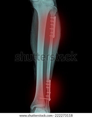 Film x-ray show fracture shaft of tibia and fibular insert plate and screw for fix leg's bone