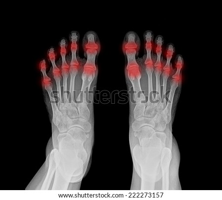 Double Foot X-ray