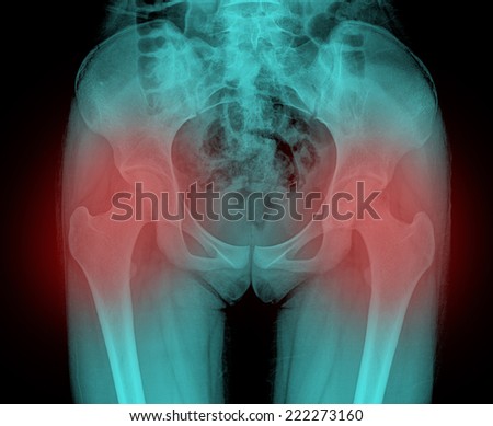 X ray film of pelvic bone