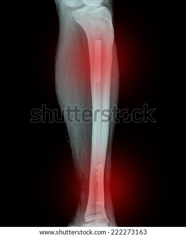 Film x-ray show fracture shaft of tibia and fibular insert plate and screw for fix leg\'s bone
