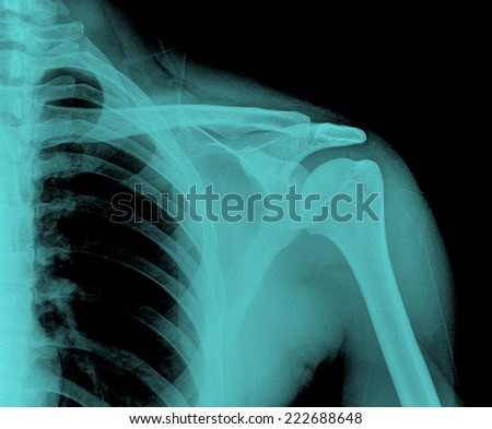 X-ray film of Right shoulder fracture ,hold 5kg