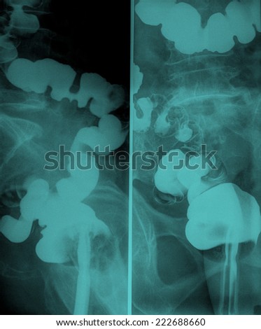 X-ray with opaque contrast medium that shows intestine: spine and hip in background