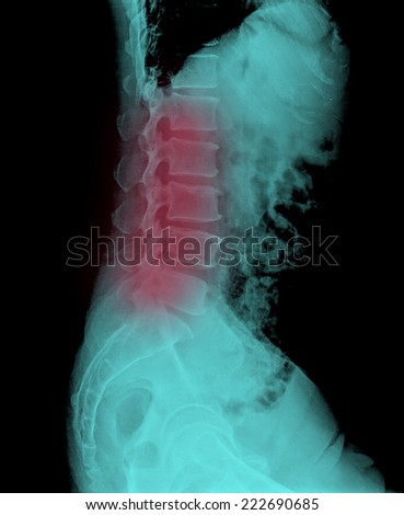 Scanning of a left lateral lumbar spine radiograph taken, among others radiographs, to try to detect the origin of pain in the hip of an adult man