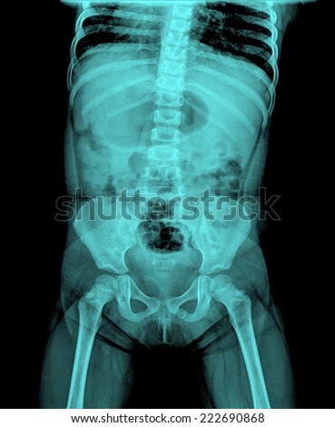 Film x-ray normal body of child