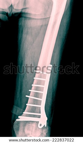 x-ray image of fracture leg ( tibia )with implant external fixation