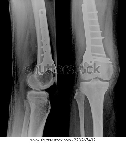 Film x-ray show fracture shaft of femur insert plate and screw for fix knee\'s bone