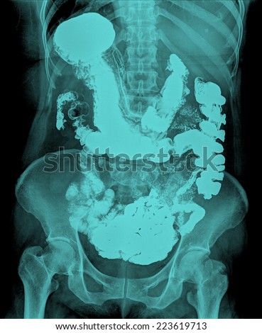 x-ray of a humen belly with lots of gas, obstruction