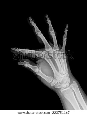 Hand X-ray. Female.