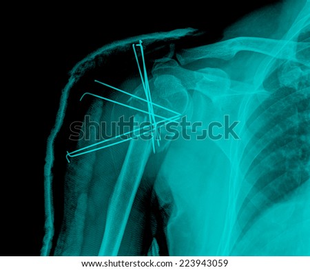 x-ray image of broken arm bone show pre-post operation (Anatomy of fracture humerus )