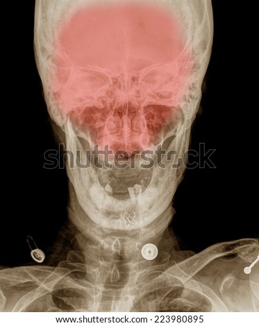 X-ray picture of the skull,open mouth