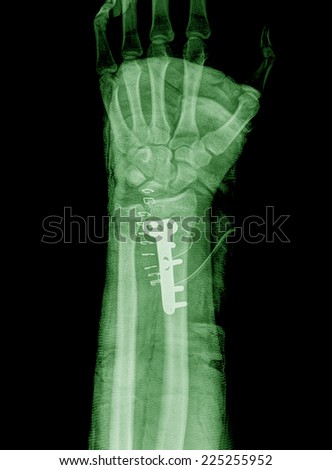 x ray broken arm bone in cast