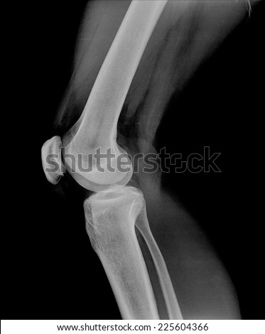 Xray of a human knee