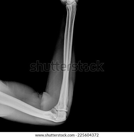 X ray image of human elbow