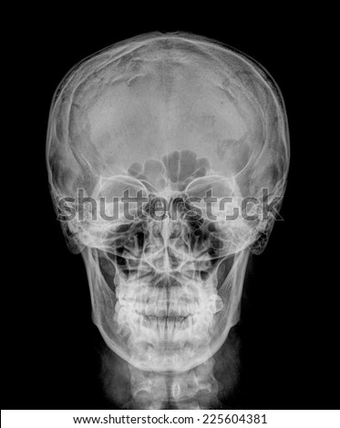Front face skull x-ray image