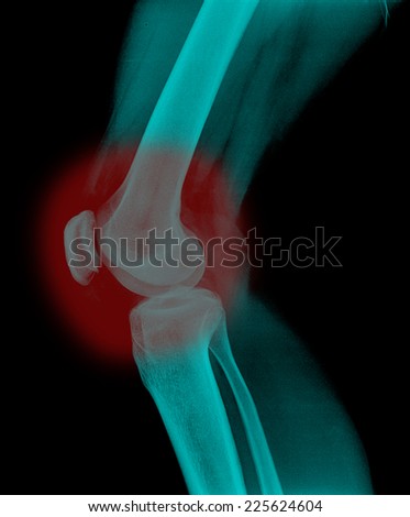 Xray of a human knee