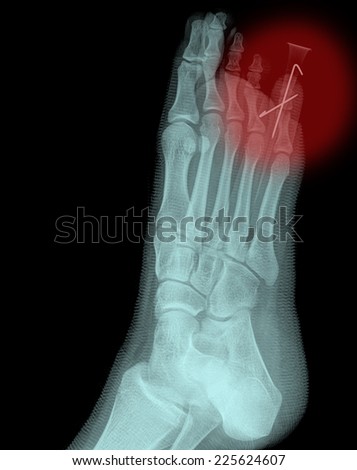 x-rays image of injury foot and toe fracture