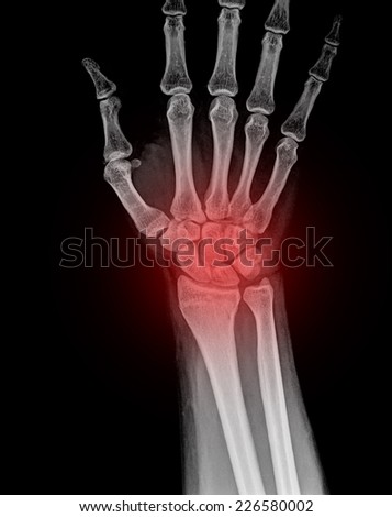 X-ray of human hand and wrist.