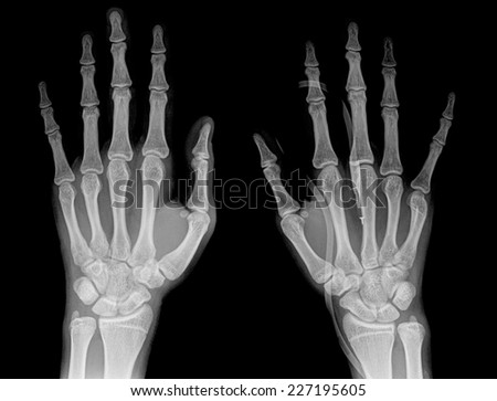 film x-ray both hand AP : show normal human\'s hands on black background (isolated)