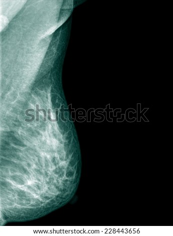 Healthy breast scan X-ray plate.