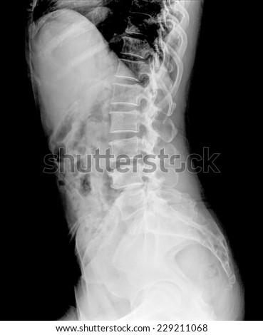 idiopathic scoliosis, last stage, deformation ribs