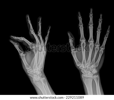 Medical X-Ray imaging of hand
