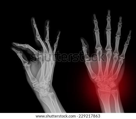 Medical X-Ray imaging of hand