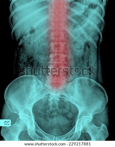 X-ray lumbo-sacral spine and pelvis and inflammation at spine