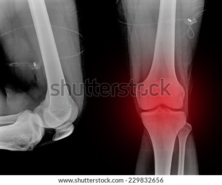 X-Ray picture of knees front and side view
