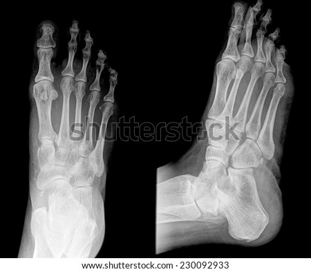 X-ray of both human feet