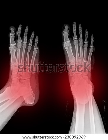 X-ray of both human feet