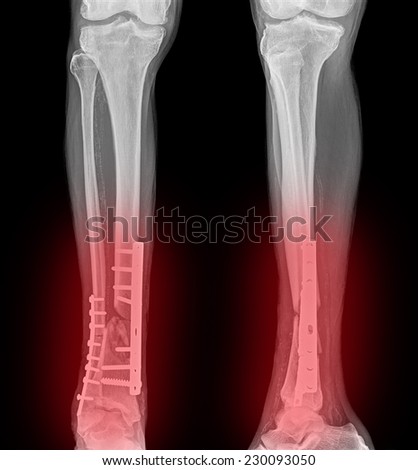 X-ray film of broken leg
