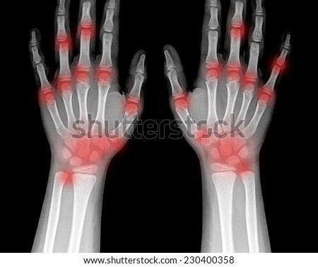 X-ray of human hand and wrist.