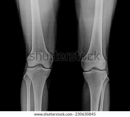 X-ray of both human knees.