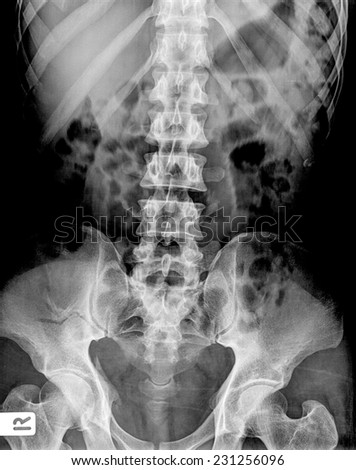 X-ray of the pelvis and spinal column.